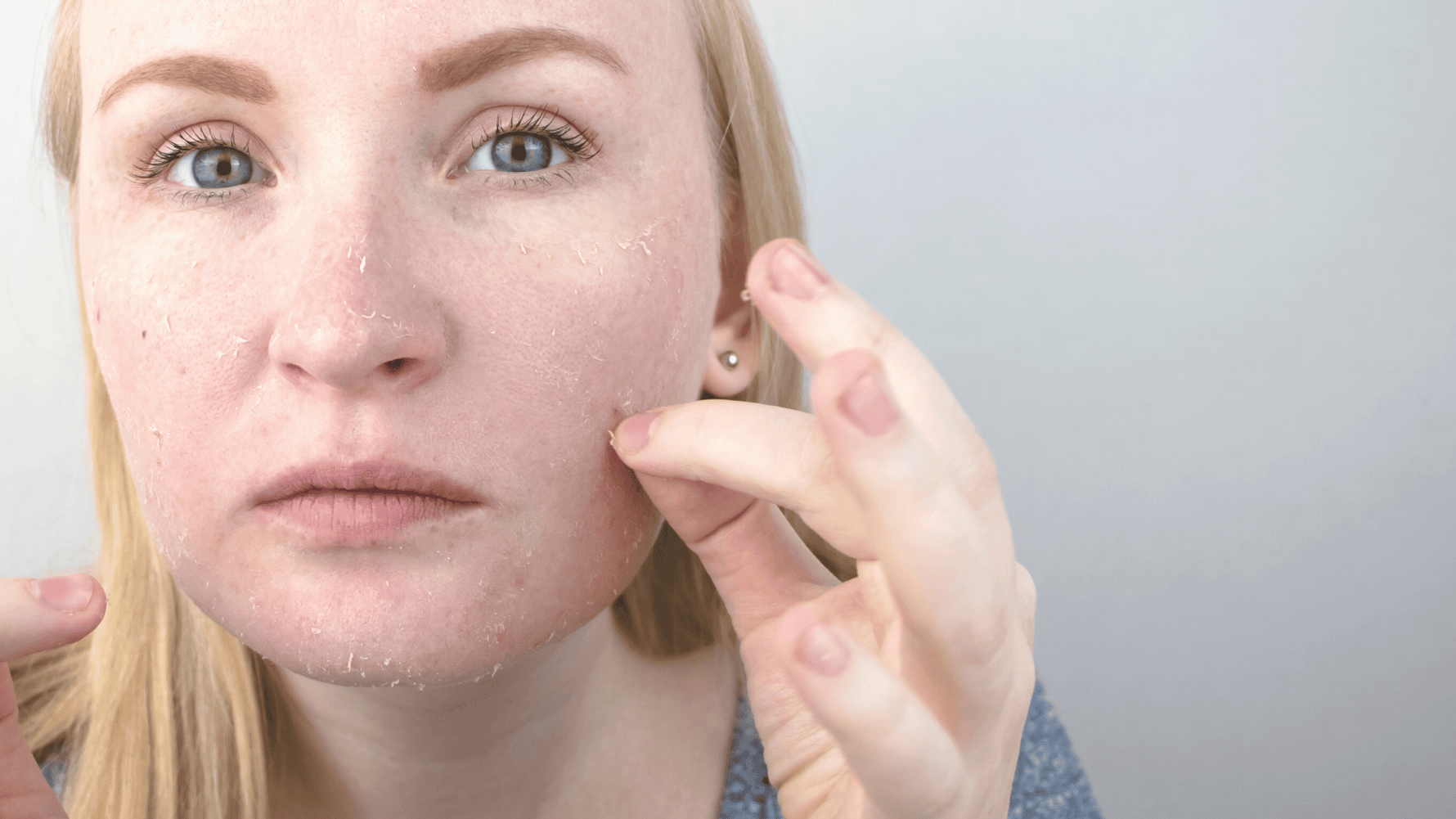 Pourquoi ma peau pèle ? Voici les causes et les solutions – Emeo Swiss